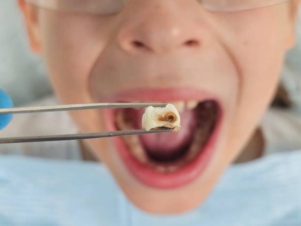 Best Emergency Dentist for Lost Fillings or Crowns in Southeast Arcadia, FL