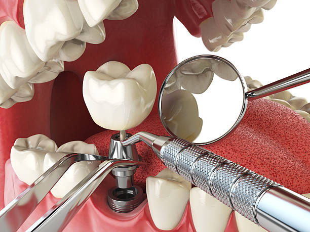 Best Emergency Dentist for Knocked-Out Tooth in Southeast Arcadia, FL